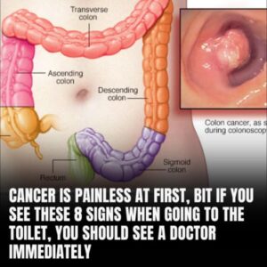 Poop and Colon Cancer: Warning Signs To Look For And When To Seek For Help