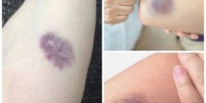 BE CAREFUL, if you get these bruises on your body, it means you have…