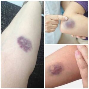 BE CAREFUL, if you get these bruises on your body, it means you have…