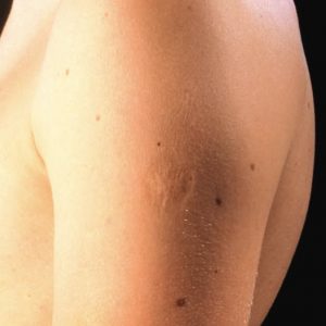 Here’s The Truth Behind This Scar On People’s Upper Left Arm