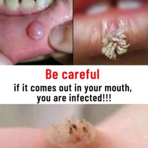 Be very careful if it comes out in your mouth, you are infected
