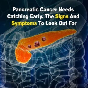 10 Warning Signs of Pancreatic Cancer You Must Not Overlook10 Warning Signs of Pancreatic Cancer You Must Not Overlook